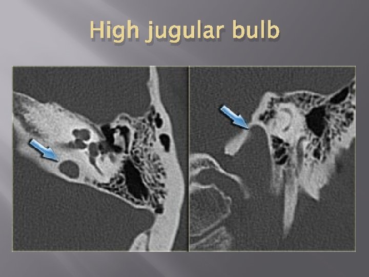 High jugular bulb 