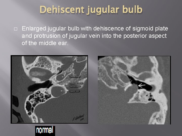 Dehiscent jugular bulb � Enlarged jugular bulb with dehiscence of sigmoid plate and protrusion