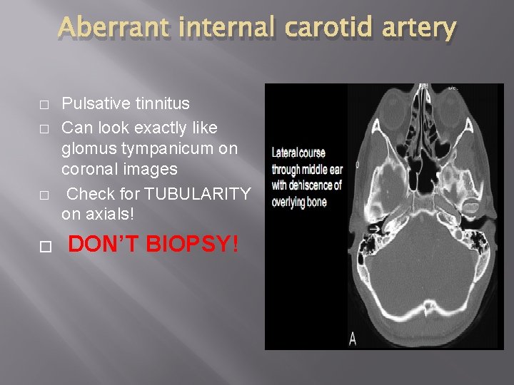 Aberrant internal carotid artery � � Pulsative tinnitus Can look exactly like glomus tympanicum