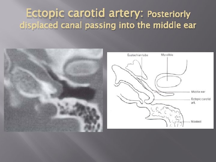 Ectopic carotid artery: Posteriorly displaced canal passing into the middle ear 