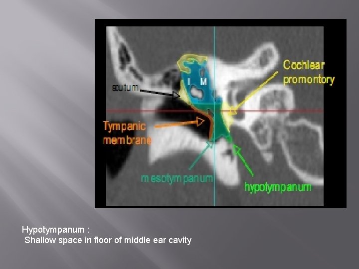 Hypotympanum : Shallow space in floor of middle ear cavity 