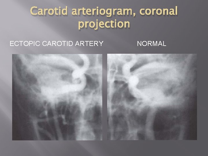 Carotid arteriogram, coronal projection ECTOPIC CAROTID ARTERY NORMAL 