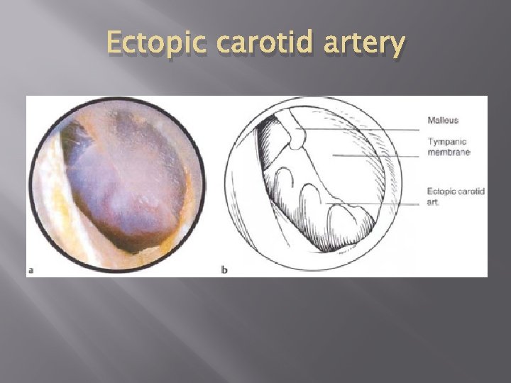 Ectopic carotid artery 