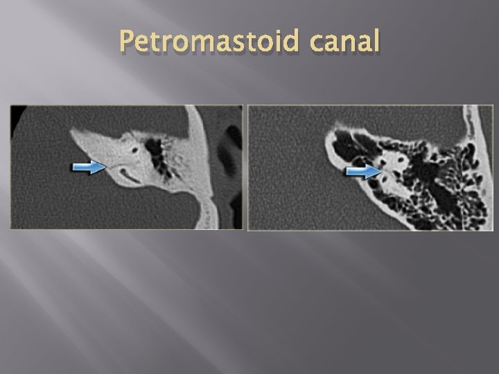 Petromastoid canal 