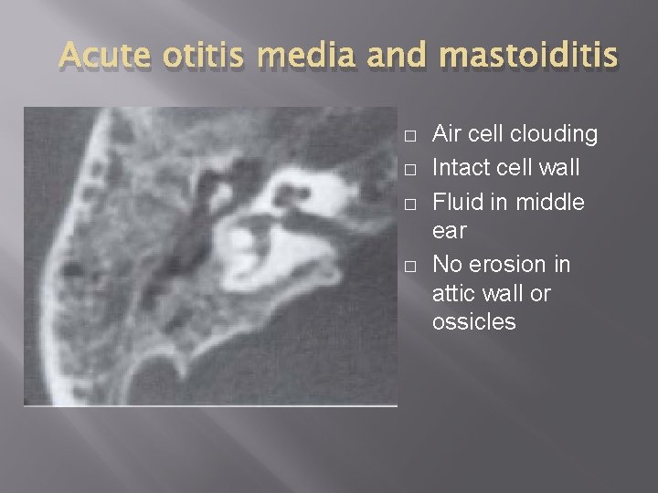 Acute otitis media and mastoiditis � � Air cell clouding Intact cell wall Fluid