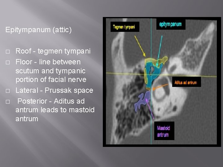 Epitympanum (attic) � � Roof - tegmen tympani Floor - line between scutum and