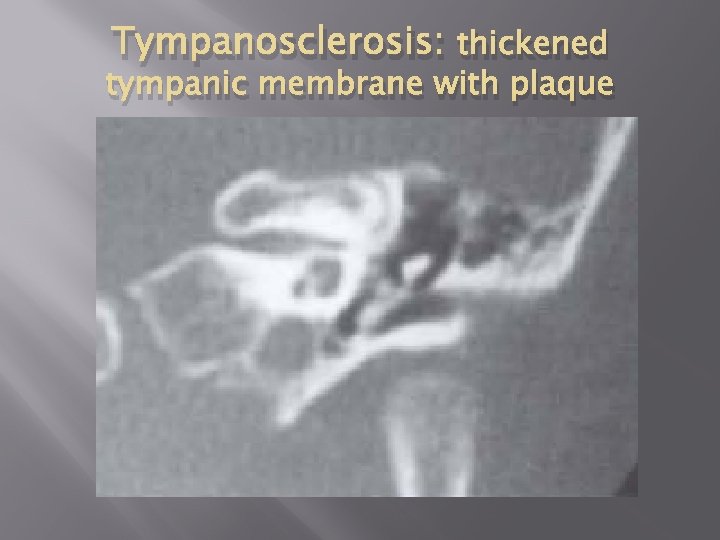 Tympanosclerosis: thickened tympanic membrane with plaque 