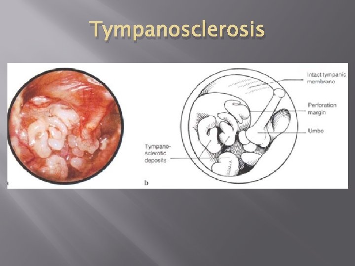 Tympanosclerosis 