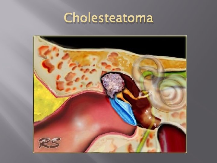 Cholesteatoma 