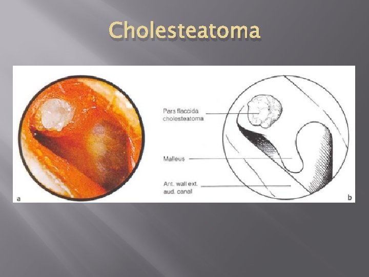 Cholesteatoma 
