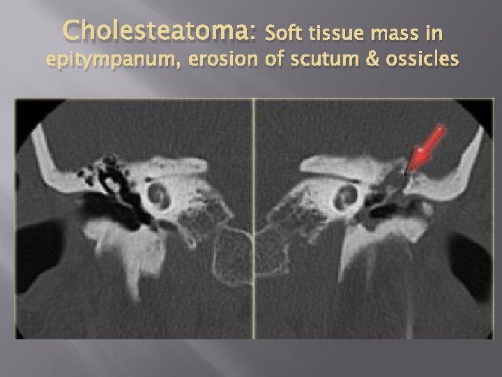 Cholesteatoma: Soft tissue mass in epitympanum, erosion of scutum & ossicles 