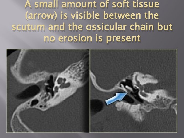 A small amount of soft tissue (arrow) is visible between the scutum and the