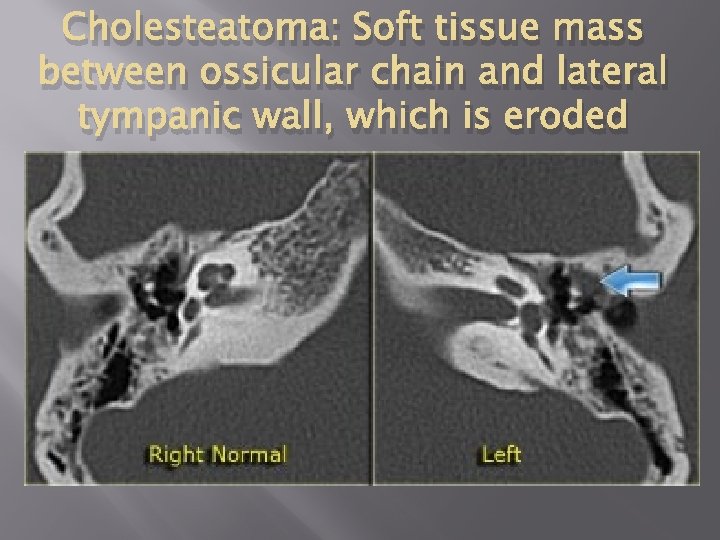 Cholesteatoma: Soft tissue mass between ossicular chain and lateral tympanic wall, which is eroded