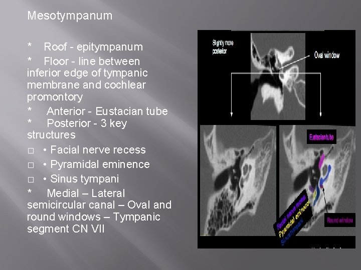 Mesotympanum * Roof - epitympanum * Floor - line between inferior edge of tympanic