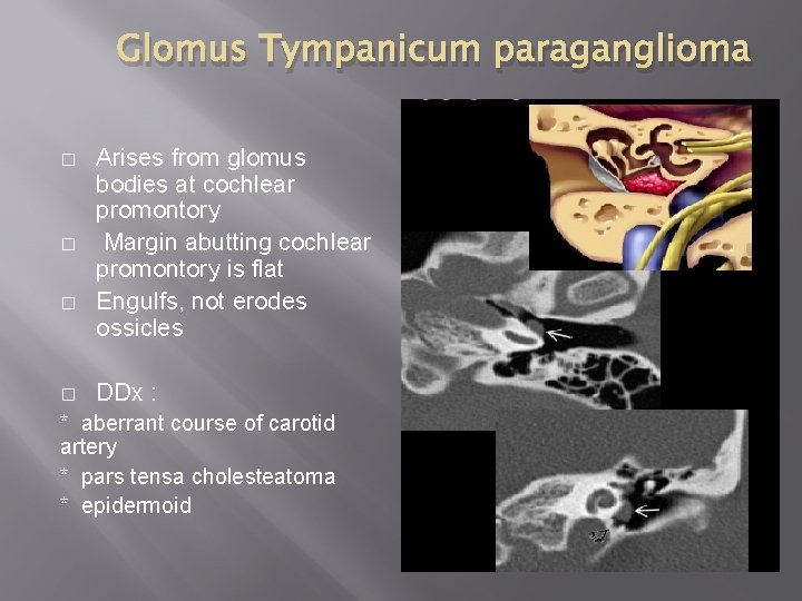 Glomus Tympanicum paraganglioma � � Arises from glomus bodies at cochlear promontory Margin abutting