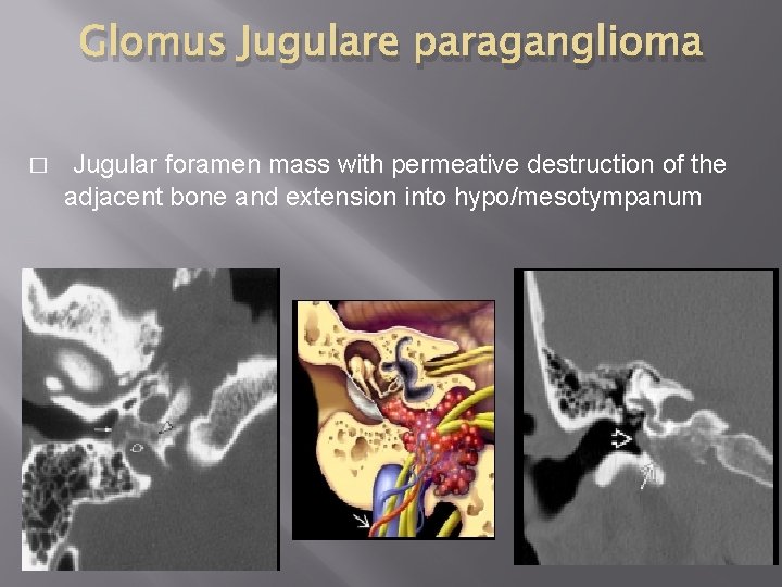 Glomus Jugulare paraganglioma � Jugular foramen mass with permeative destruction of the adjacent bone