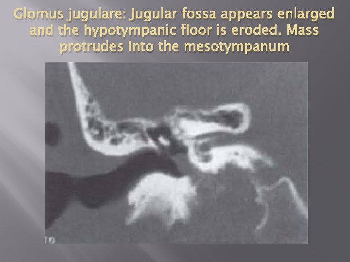 Glomus jugulare: Jugular fossa appears enlarged and the hypotympanic floor is eroded. Mass protrudes