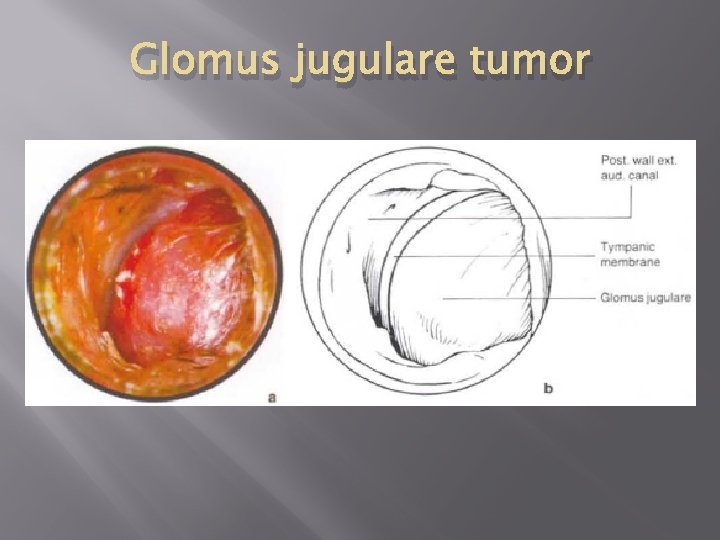 Glomus jugulare tumor 