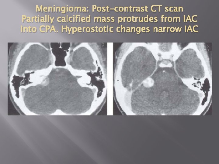 Meningioma: Post-contrast CT scan Partially calcified mass protrudes from IAC into CPA. Hyperostotic changes