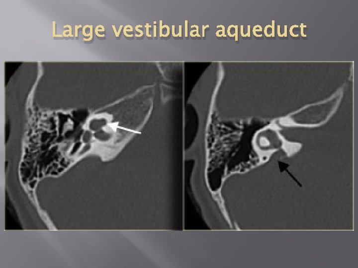 Large vestibular aqueduct 