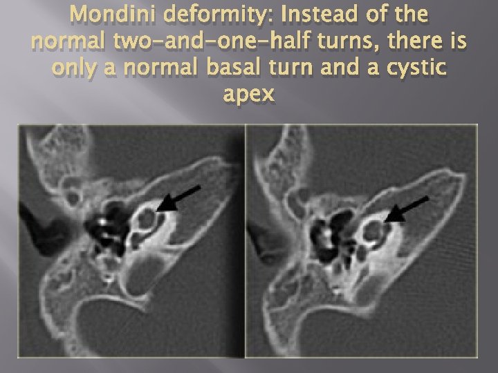 Mondini deformity: Instead of the normal two-and-one-half turns, there is only a normal basal