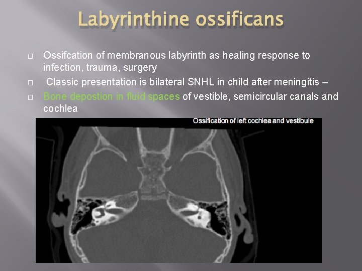 Labyrinthine ossificans � � � Ossifcation of membranous labyrinth as healing response to infection,