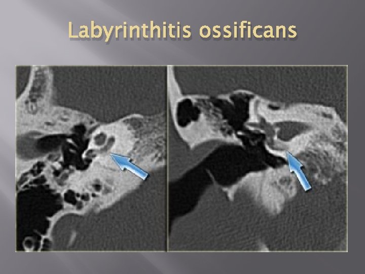 Labyrinthitis ossificans 