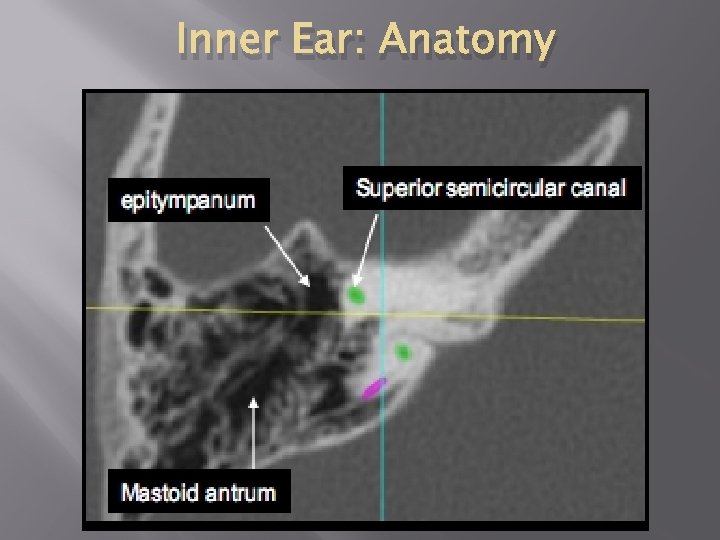 Inner Ear: Anatomy 