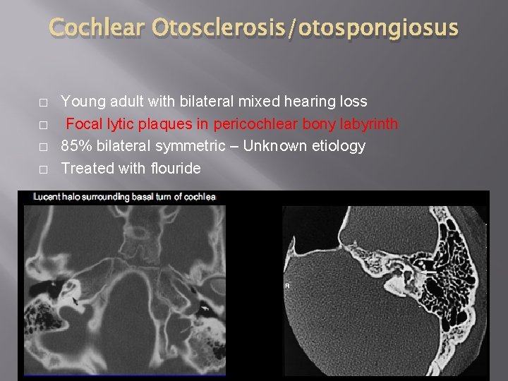 Cochlear Otosclerosis/otospongiosus � � Young adult with bilateral mixed hearing loss Focal lytic plaques