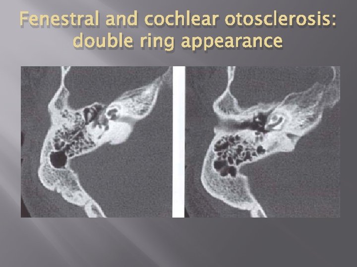 Fenestral and cochlear otosclerosis: double ring appearance 