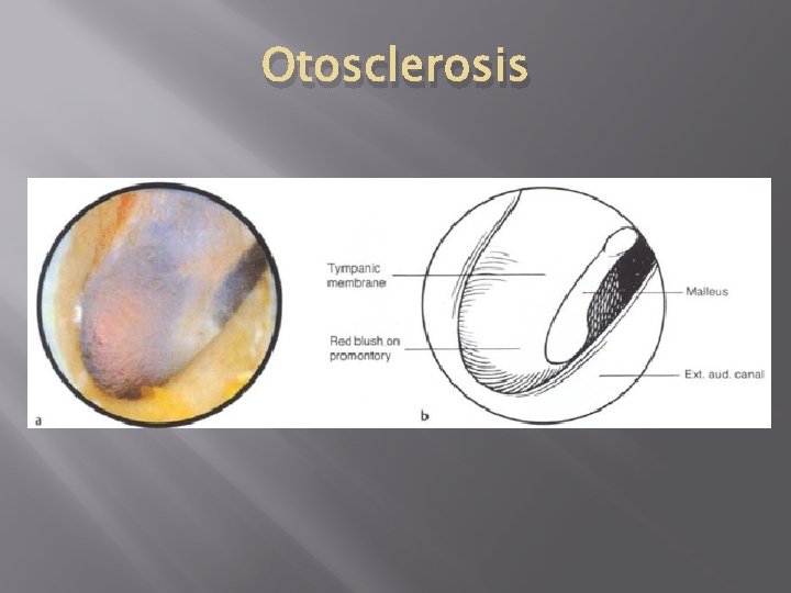 Otosclerosis 