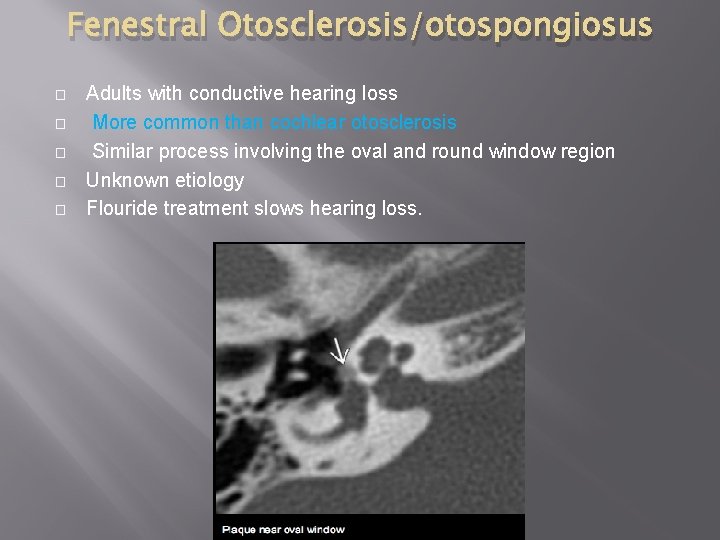 Fenestral Otosclerosis/otospongiosus � � � Adults with conductive hearing loss More common than cochlear