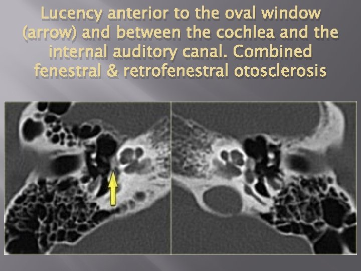 Lucency anterior to the oval window (arrow) and between the cochlea and the internal