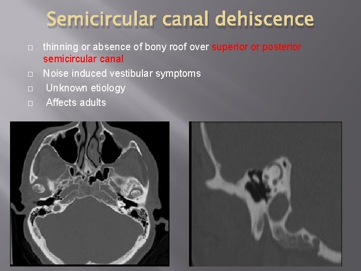 Semicircular canal dehiscence � � thinning or absence of bony roof over superior or