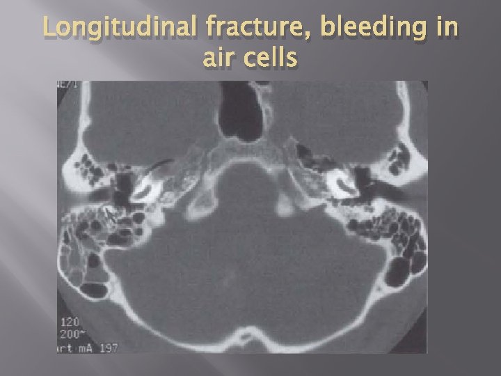 Longitudinal fracture, bleeding in air cells 