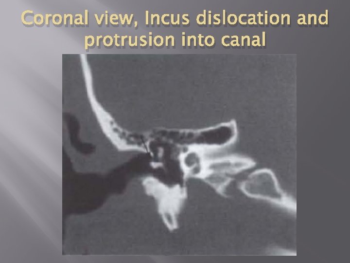 Coronal view, Incus dislocation and protrusion into canal 