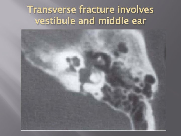 Transverse fracture involves vestibule and middle ear 