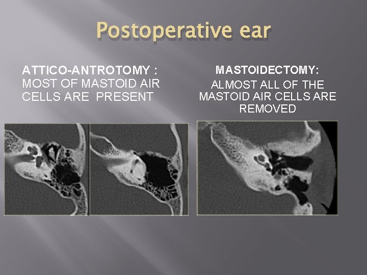 Postoperative ear ATTICO-ANTROTOMY : MOST OF MASTOID AIR CELLS ARE PRESENT MASTOIDECTOMY: ALMOST ALL