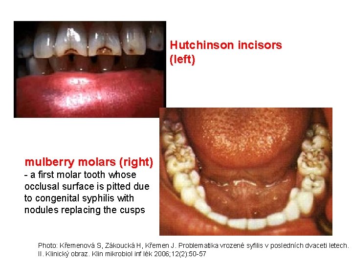 Hutchinson incisors (left) mulberry molars (right) - a first molar tooth whose occlusal surface