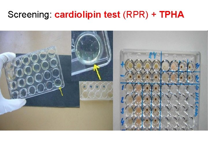 Screening: cardiolipin test (RPR) + TPHA 