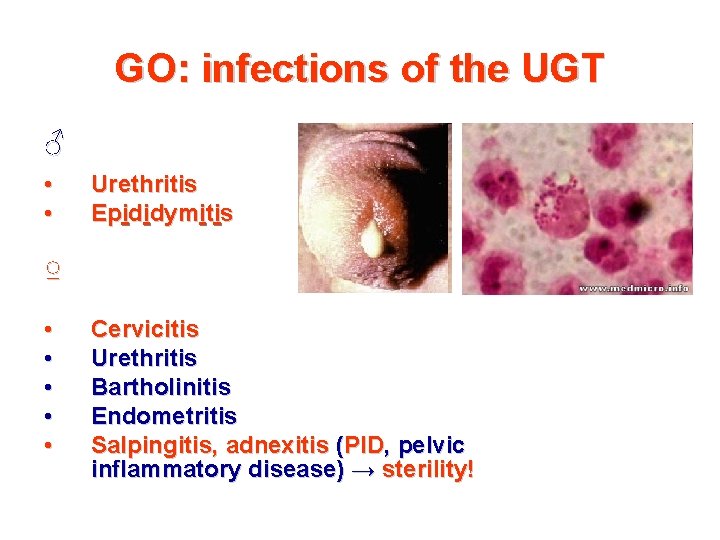 GO: infections of the UGT ♂ • • Urethritis Epididymitis ♀ • • •