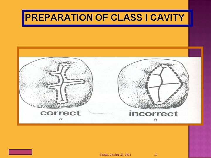 PREPARATION OF CLASS I CAVITY Friday, October 29, 2021 17 