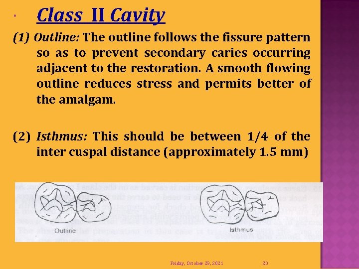  Class II Cavity (1) Outline: The outline follows the fissure pattern so as