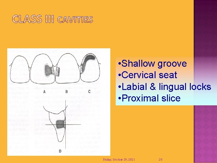  • Shallow groove • Cervical seat • Labial & lingual locks • Proximal