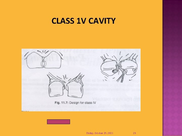 CLASS 1 V CAVITY Friday, October 29, 2021 29 