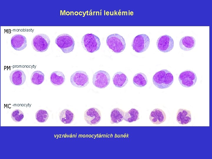 Monocytární leukémie -monoblasty -promonocyty -monocyty vyzrávání monocytárních buněk 