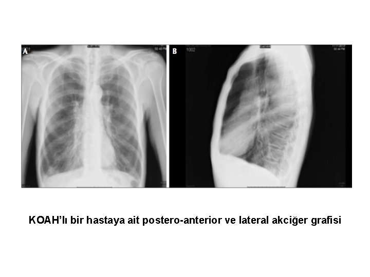KOAH’lı bir hastaya ait postero-anterior ve lateral akciğer grafisi 