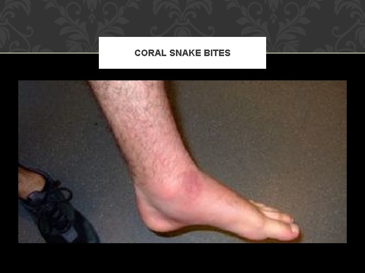 CORAL SNAKE BITES 