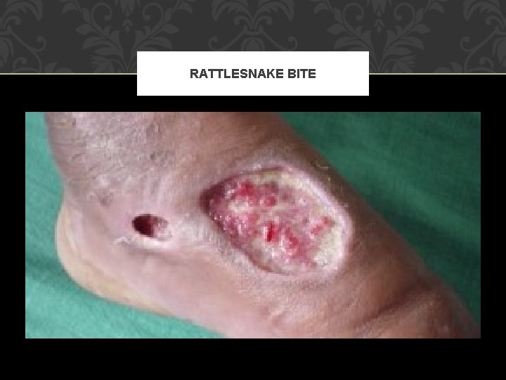 RATTLESNAKE BITE 