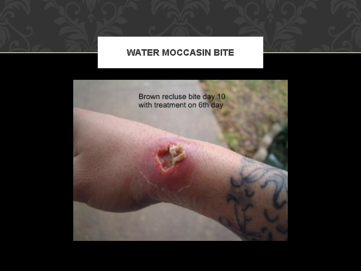 WATER MOCCASIN BITE 